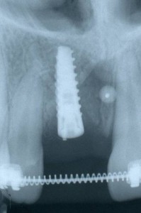 Radiografia dell'impianto