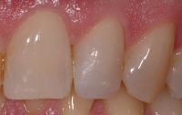 dentistica conservativa dopo